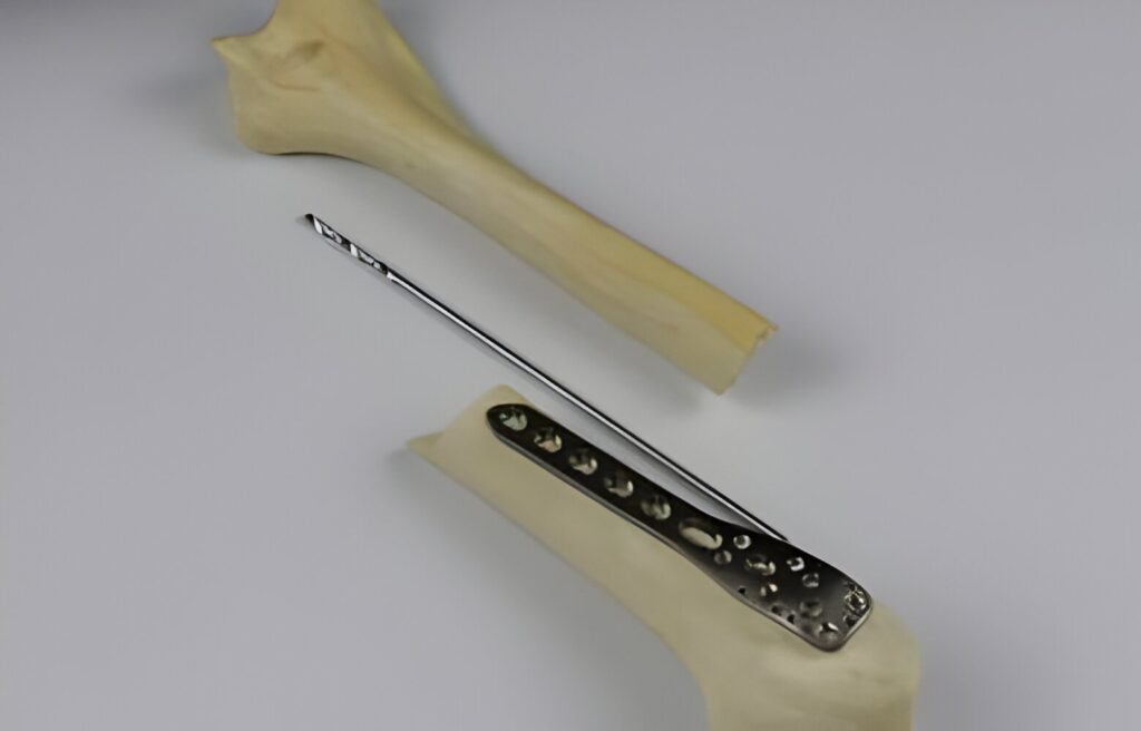 Bone Plates