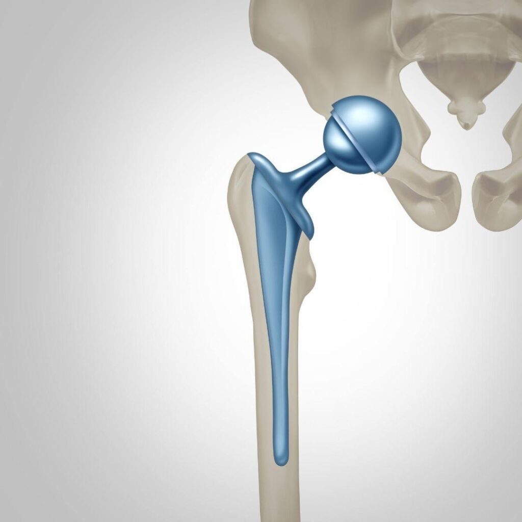 Hip Prosthesis